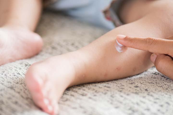 calamine lotion for baby acne