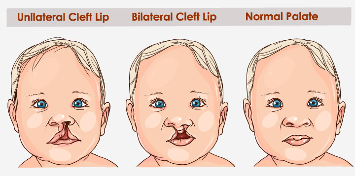 cleft lip in children and how does it happen