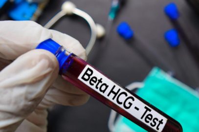 HCG Blood Pregnancy Test: How It Works & How To Detect Results