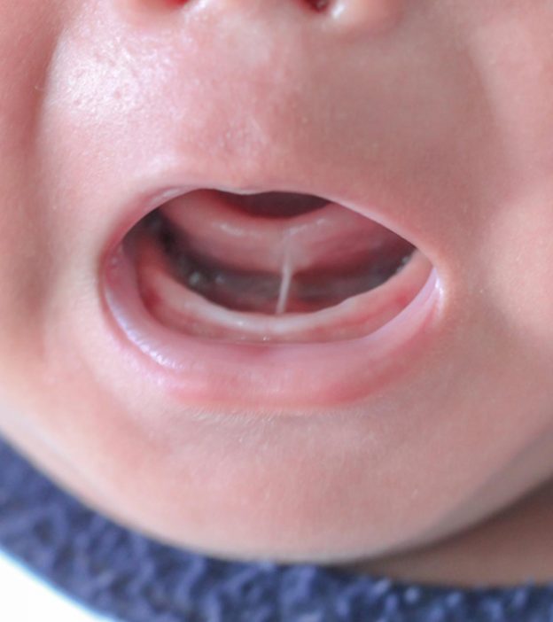 बच्चों में चिपकी हुई जीभ (टंग टाई): लक्षण, उपचार व लागत | Tongue Tied Meaning In Hindi
