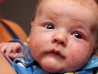 Eczema In Infants: Causes, Symptoms, Treatment And Home Remedies