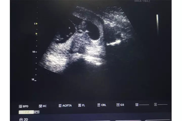 Superfetation A Brief History