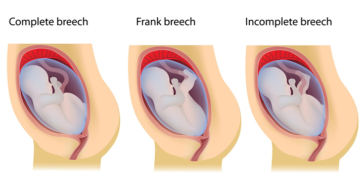 Types of breech position 