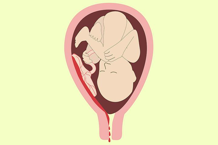 implantation-bleeding-in-tamil