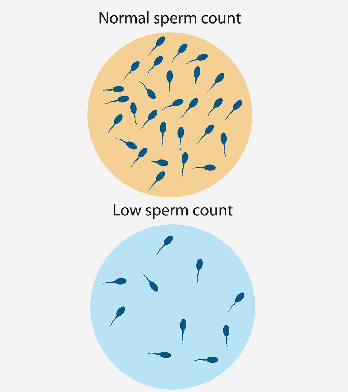 शुक्राणु की कमी (Low Sperm Count) : लक्षण, निदान और इलाज | Sperm Motility In Hindi