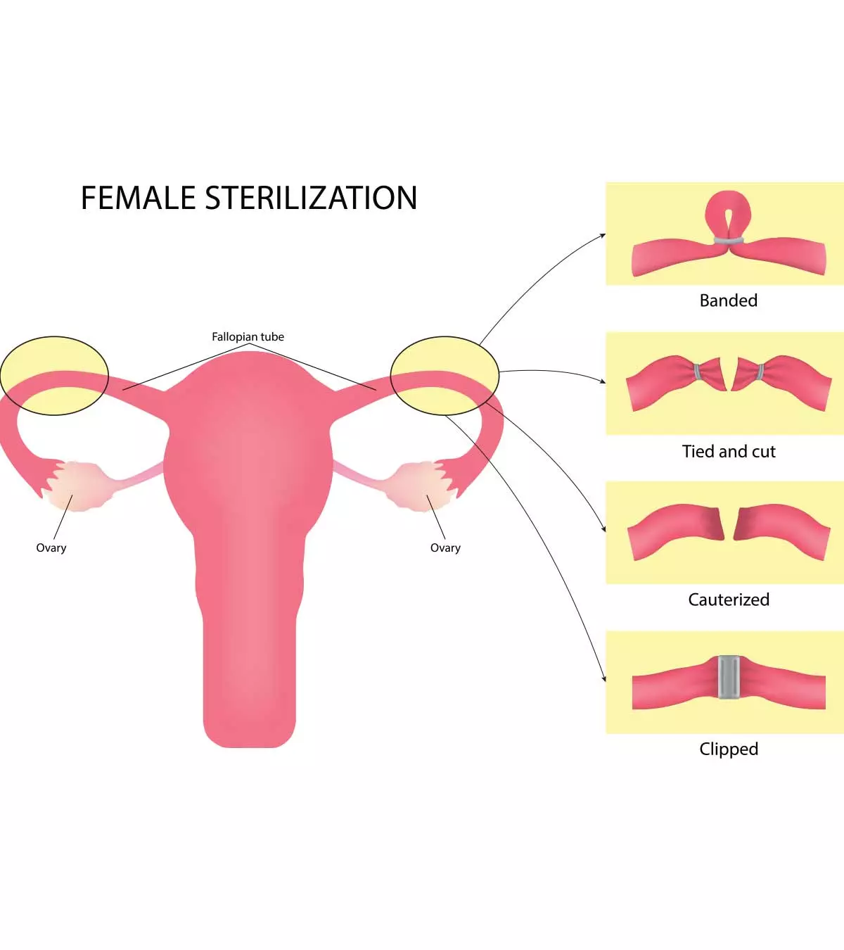 महिला नसबंदी: प्रक्रिया, लागत व ऑपरेशन के बाद देखभाल | Female Sterilization In Hindi