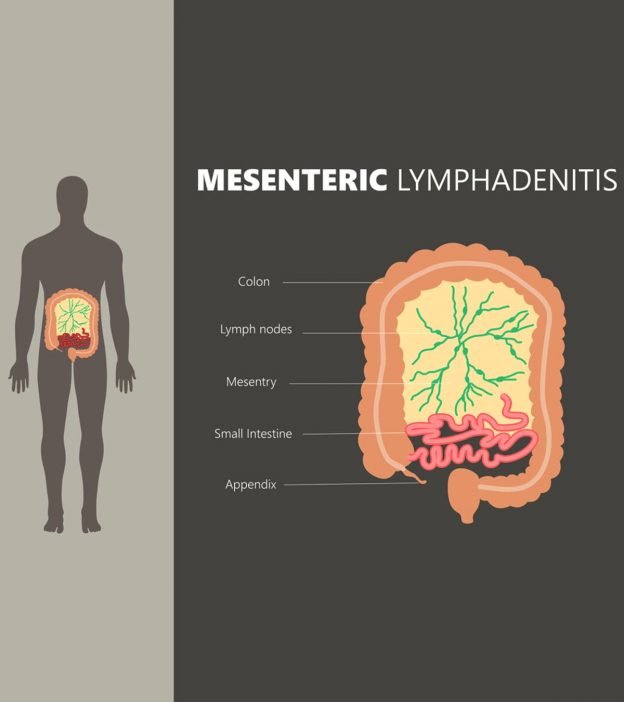 Mesenteric Lymphadenitis In Children: Symptoms And Treatment