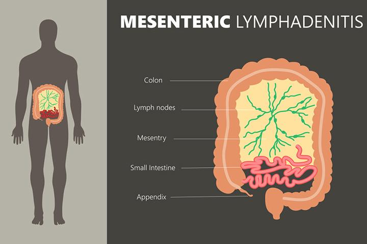 mesenteric-lymphadenitis-in-children-causes-and-treatment