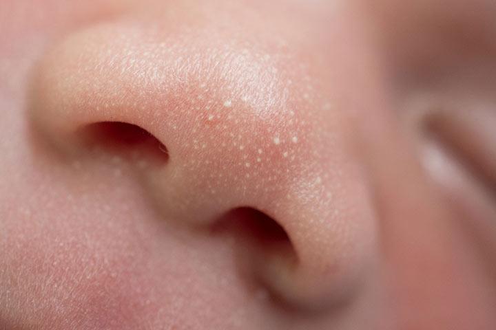 Newborn Baby With White Bumps On Skin