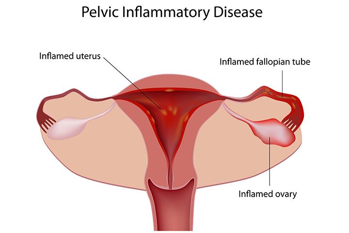 प आईड Pid क य ह क रण लक षण व उपच र Pelvic Inflammatory Disease Meaning In Hindi