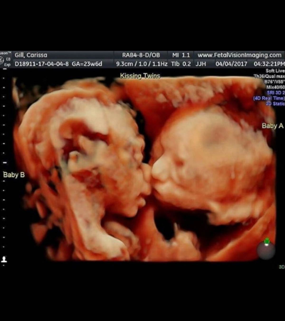 Pregnant Mom’s Ultrasound Reveals Twin Babies “Kissing” Inside The Womb
