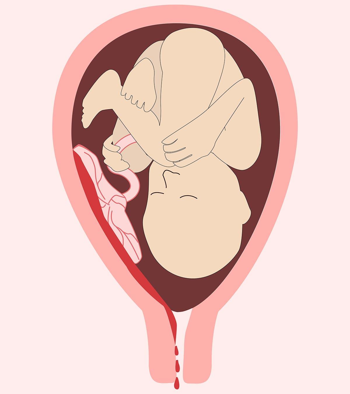 bleeding during pregnancy in tamil