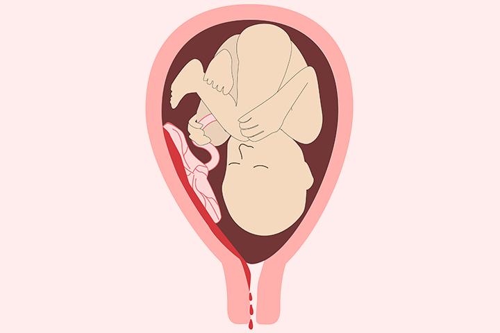 Bleeding During Pregnancy In Tamil