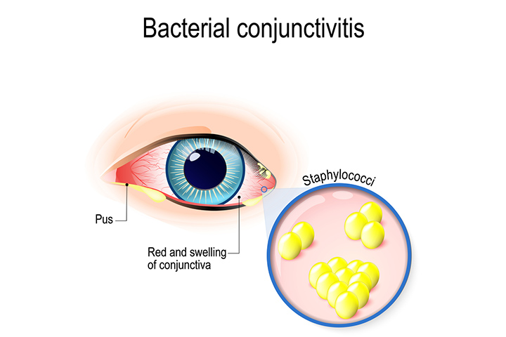 Bacterial conjunctivitis, swollen eyelids in children