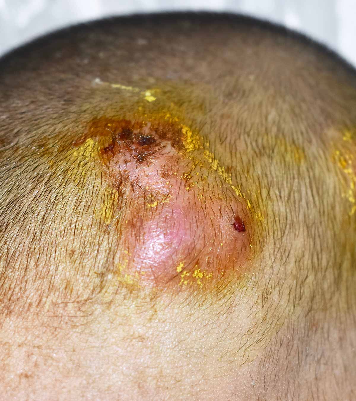 Discover 135+ pimple on head under hair super hot