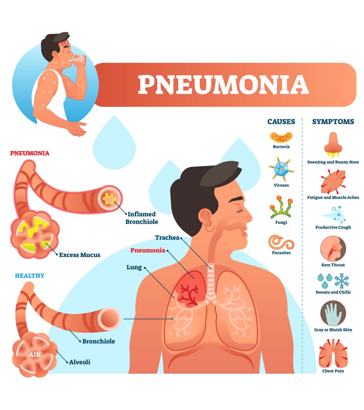 Pneumonia In Teens: Symptoms, Causes, Treatment & Prevention
