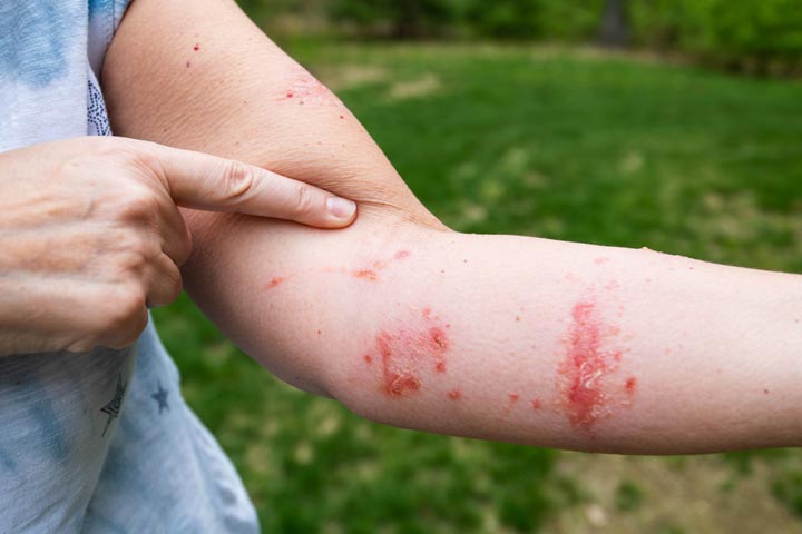 Poison Ivy On Kids Causes Pictures Remedies And Treatment