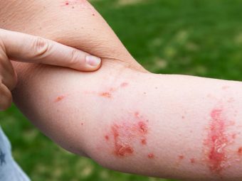 Poison Ivy Rash On Children: Symptoms And Treatment