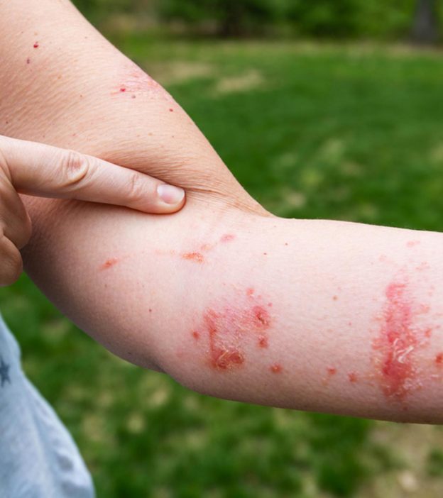 Poison Ivy Rash On Children Symptoms And Treatment