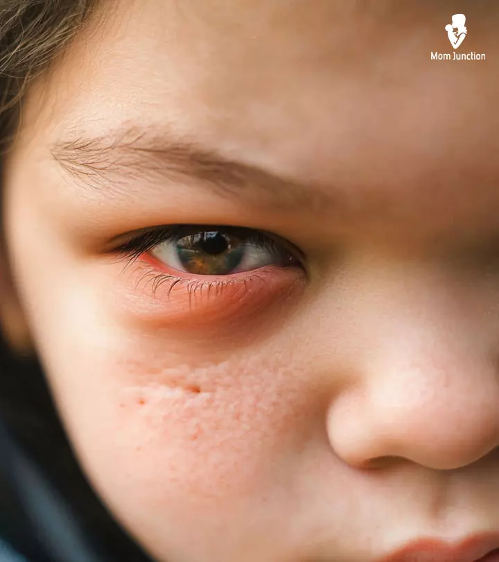 Causes Of Swollen Eyelids In Children