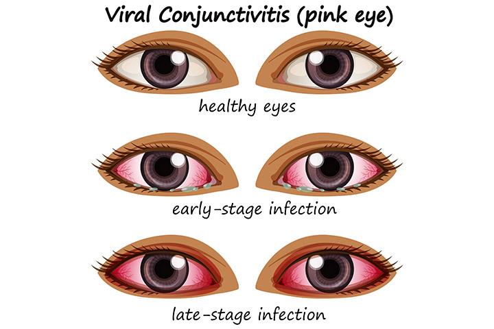 Swollen Eyelids? Causes & How to Fix Them (Fast)