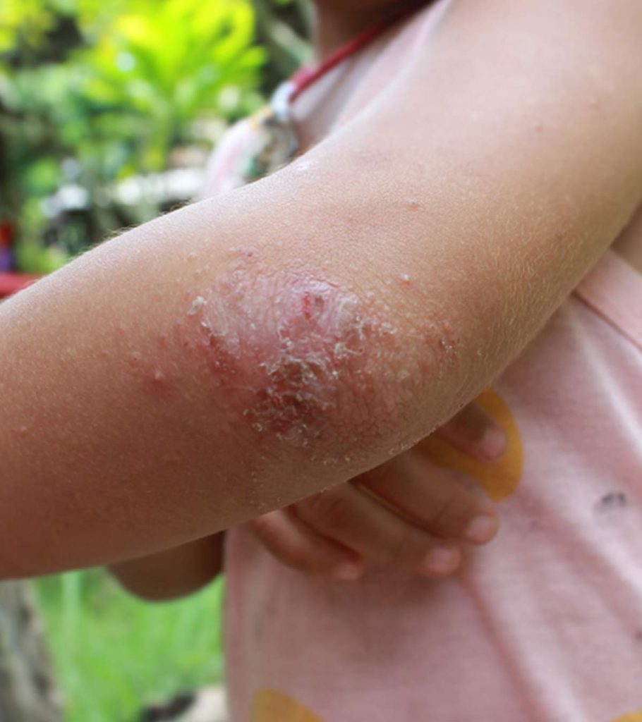 palmoplantar psoriasis in child)