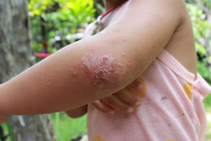 Volon tinktúra psoriasis