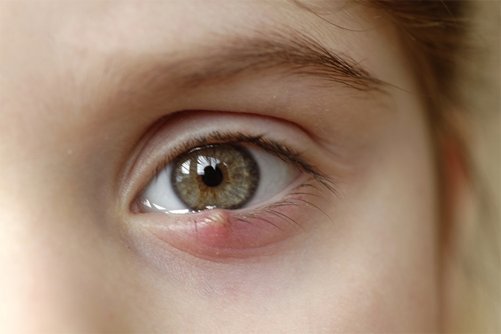 Stye, swollen eyelids in children