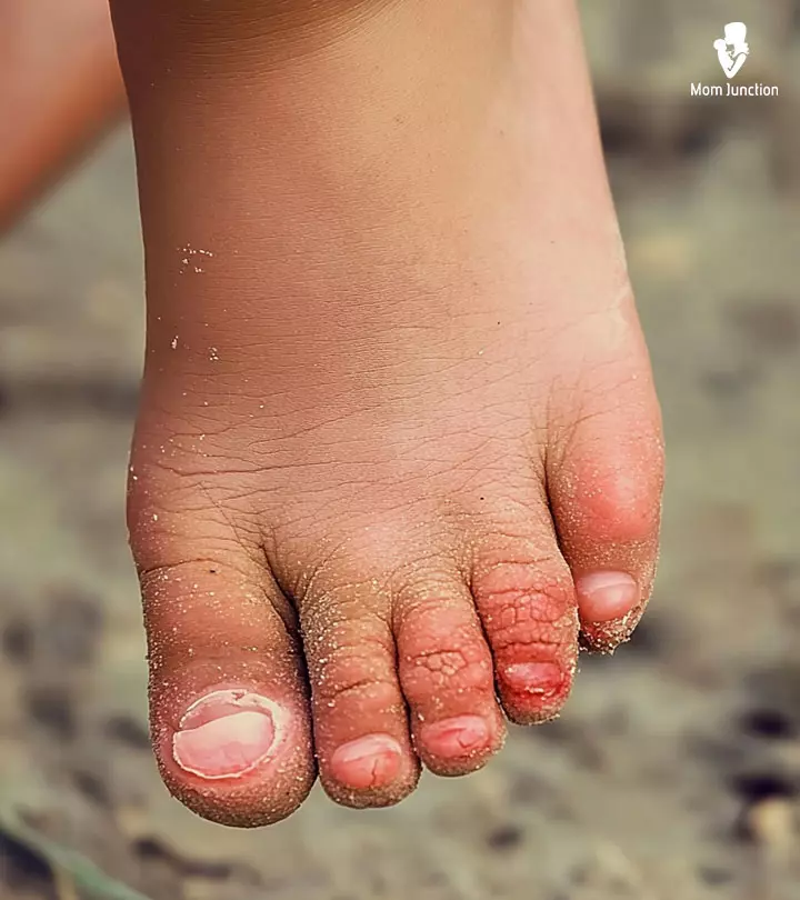 Remedies For Athlete’s Foot In Children