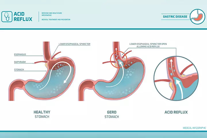 the difference between acid relux and an ulcer