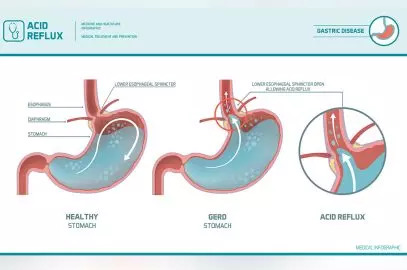 青少年的胃酸反流（GERD）：症状，原因和治疗