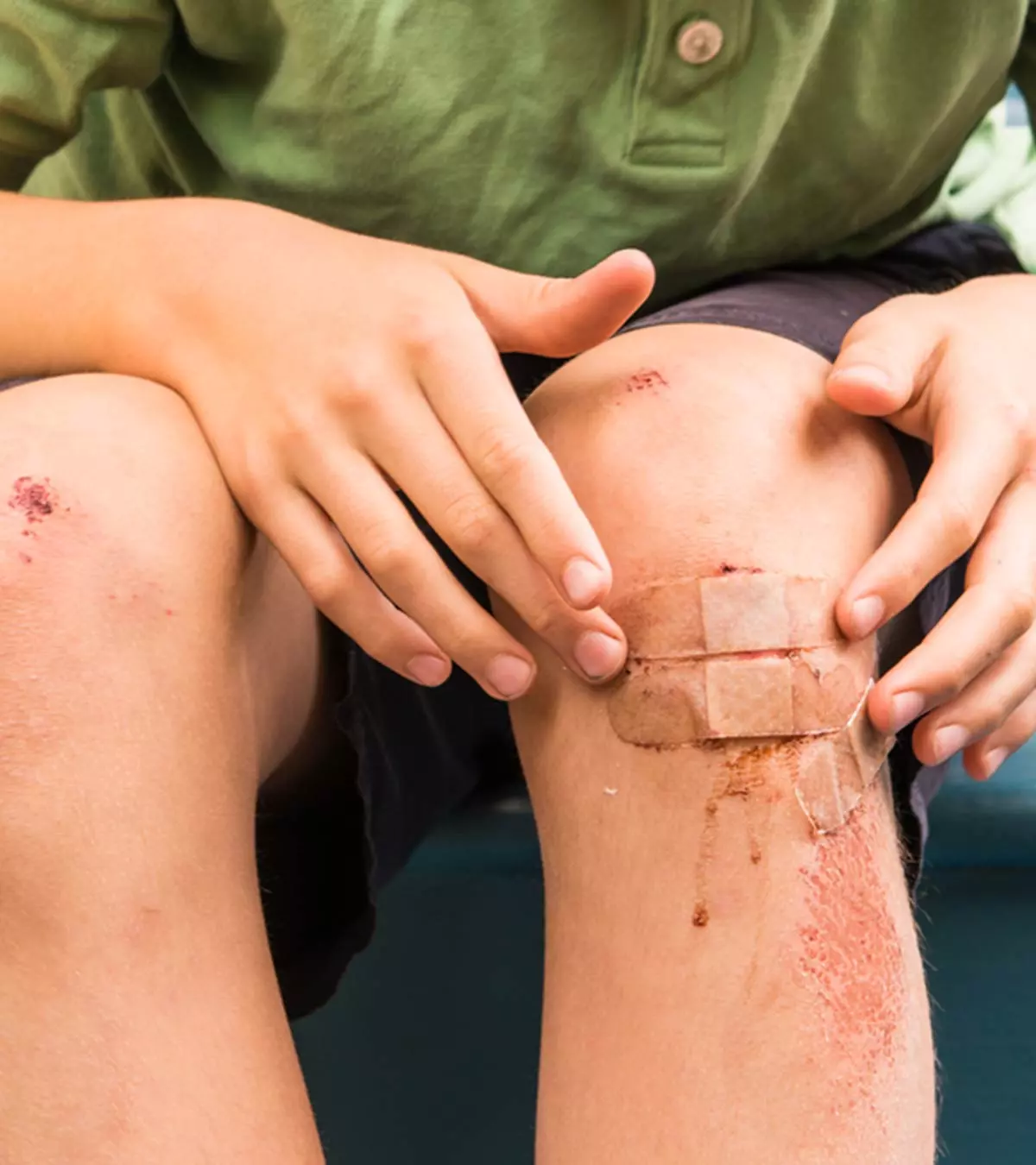 Abnormal Bruising In Children: Signs, Causes And Treatments_image