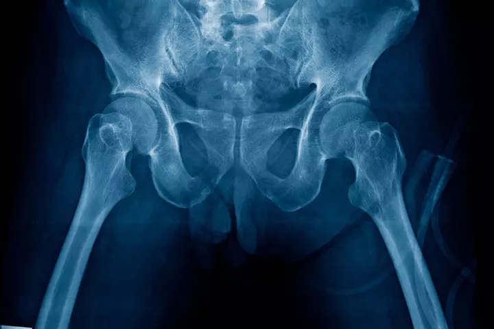 Childbearing Hips Do They Make Any Difference In Childbirth1