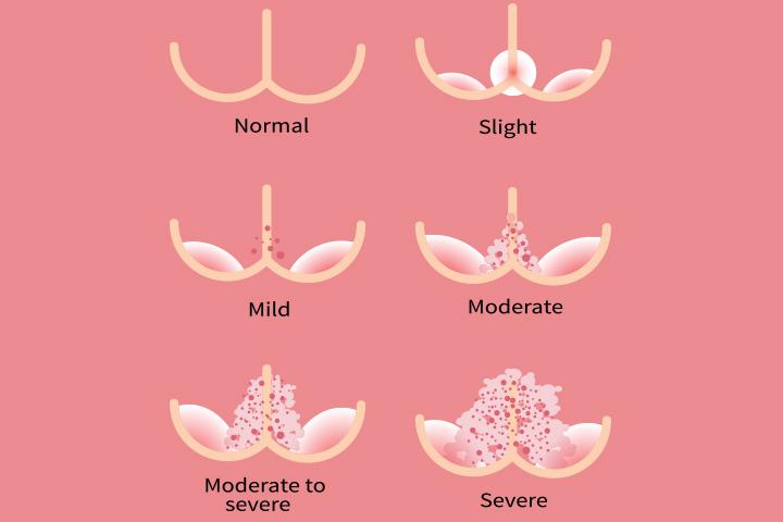 PDF) Clinical presentation and treatment of diaper dermatitis - Part II