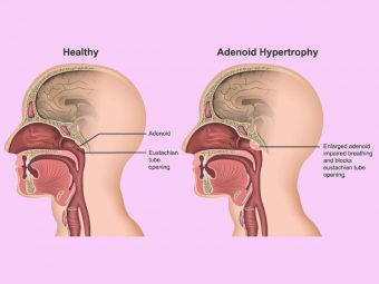Enlarged Adenoids In Children: Symptoms, Removal, And Treatment