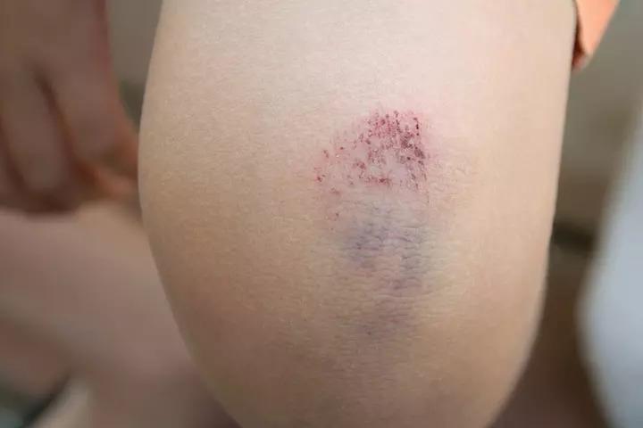 bruise-types-symptoms-causes-prevention-treatment