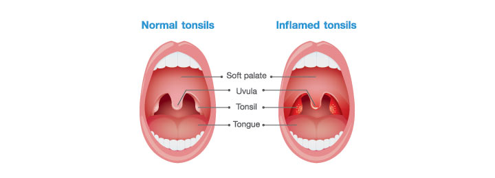 How Does Tonsillitis Look In Children.jpg