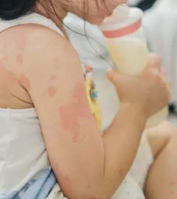 Milk Allergy In Children Causes, Symptoms, And Treatment