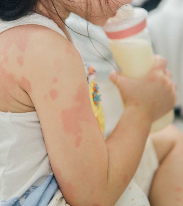 6 Important Signs And Causes Of Milk Allergy In Children