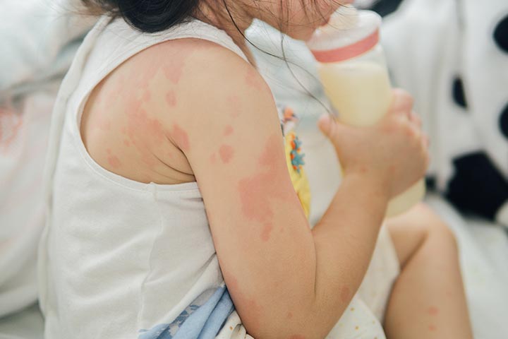 6 Signs And Symptoms Of Milk Allergy In Kids