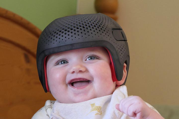 Pediatricians suggest using helmets for coneheaded babies