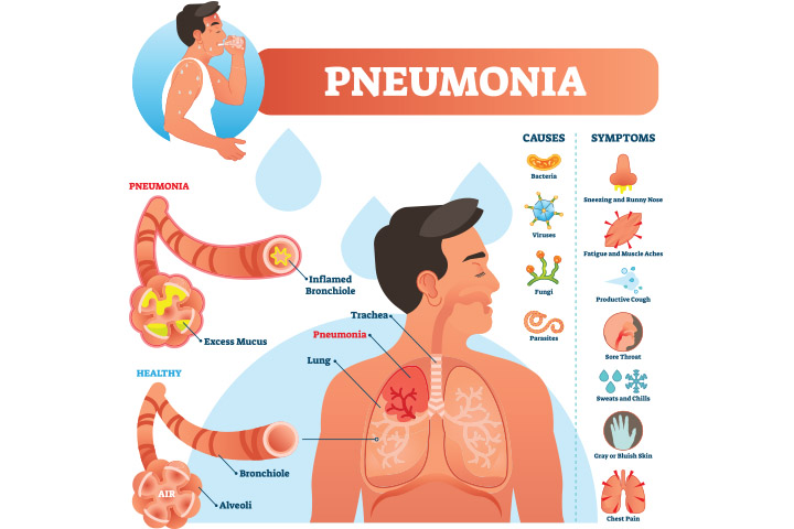 Fungal and bacterial infections may lead to Pneumonia