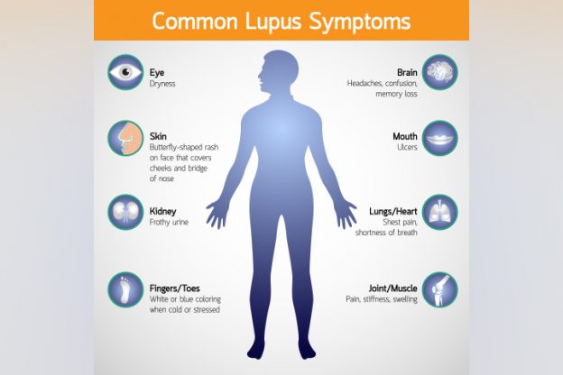 16 Symptoms Of Lupus In Children Causes And Treatment