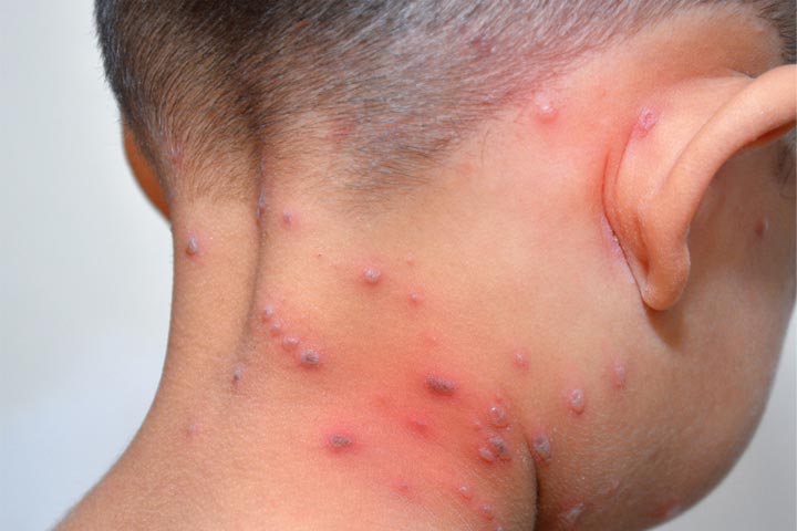 Viral rashes in babies, chickenpox