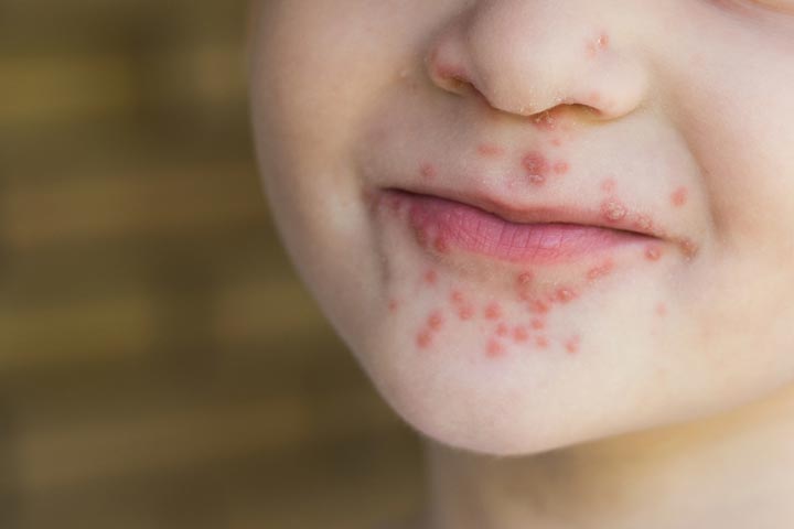 Viral rashes in babies, hand, foot, and mouth disease