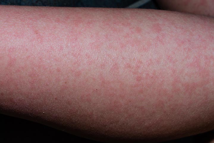 Viral rashes in babies, fifth disease