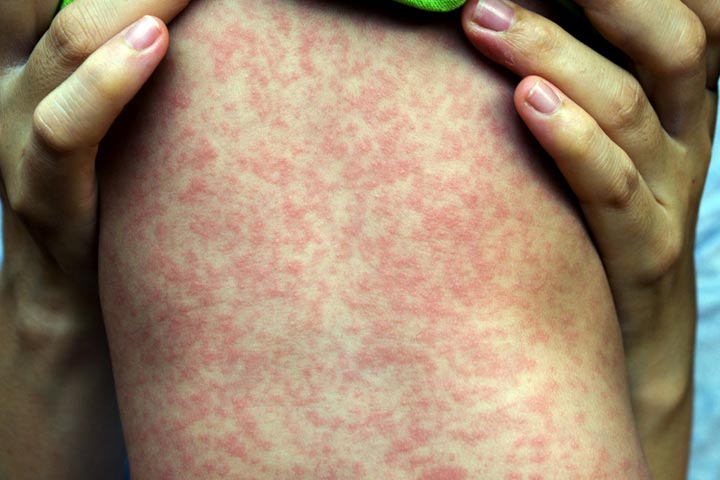 Viral rashes in babies, measles