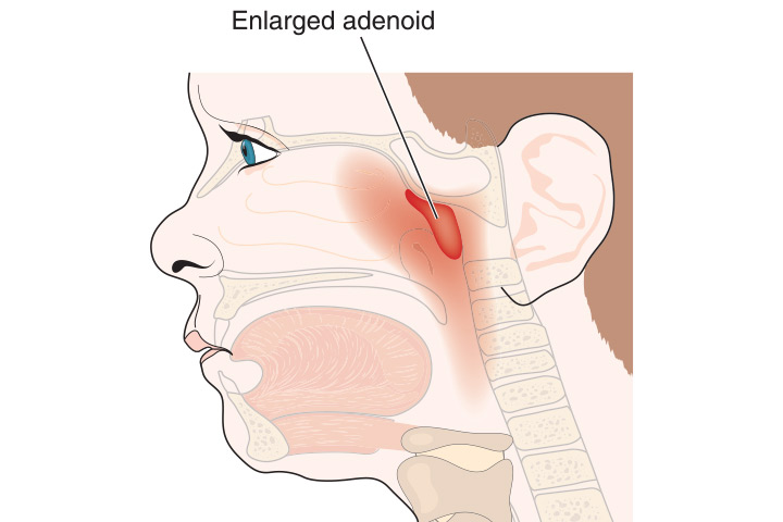 The adenoids in children