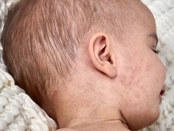 Viral Rashes In Babies: Types, Treatment & Prevention Tips