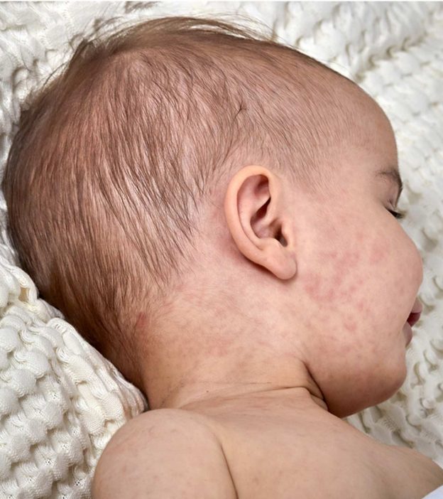 Viral Rashes In Babies: Types, Treatment & Prevention Tips